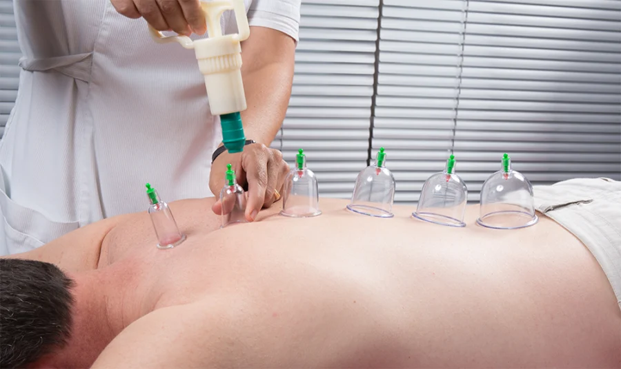 Dry cupping therapy being performed on a patient’s back