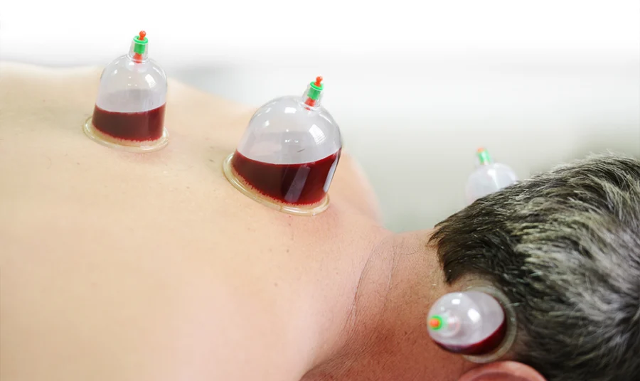Wet hijama cupping therapy session in progress