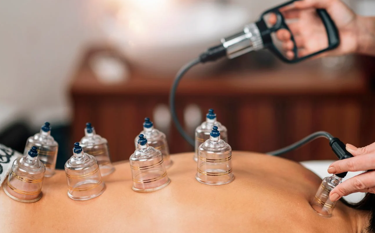 What To Expect After Cupping Therapy
